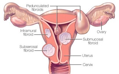 Fibroids